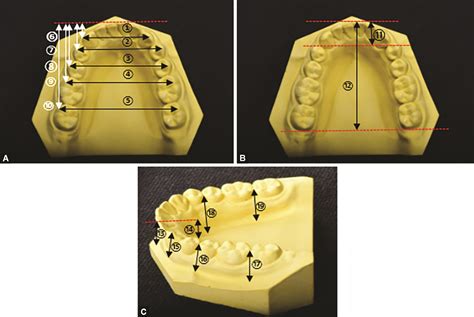 Analysis of the Facial Measurements and Dental Arch Dimensions for the ...