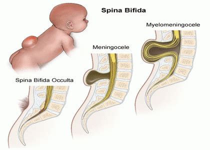 Spina Bifida Occulta Hair Patch