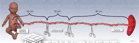 Umbilical Cord