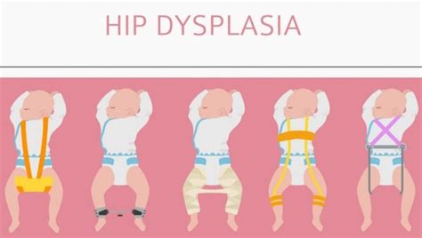 The Journey Of Infant Hip Dysplasia: From Diagnosis to Management – Babies Carrier