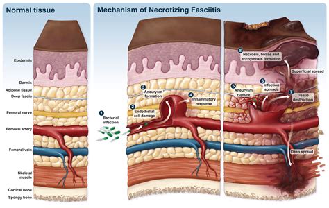 Necrotizing Fasciitis Secondary to Mycotic Femoral Aneurysm: A Narrative Review of Diagnosis and ...