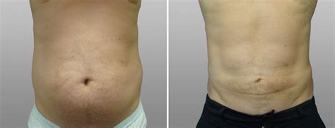 Male Liposuction Before and After Images | Form & Face