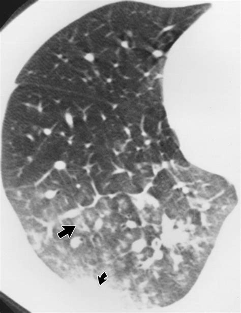 Mycoplasma Pneumoniae X Ray