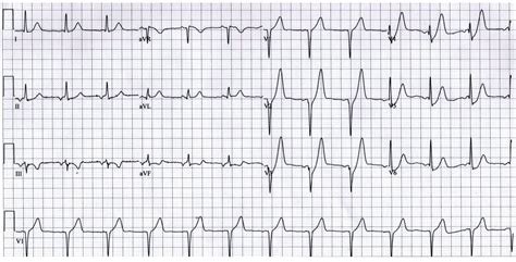 emDOCs.net – Emergency Medicine EducationSubtle ECG findings in ACS: Part II Hyperacute T-Waves ...