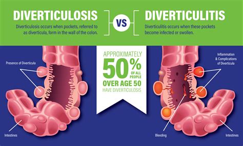 [Solved] Explain the difference between diverticulosis and diverticulitis to... | Course Hero