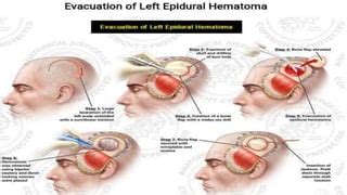 lucid interval and its importance in trauma and mental health | PPT