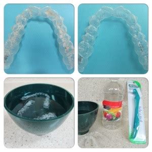 How To Clean An Invisalign Retainer - Constructiongrab Moonlightchai