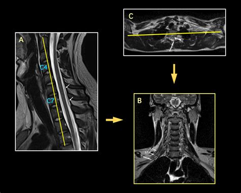 MRI BLOG: Brachial Plexus MRI (I/II)