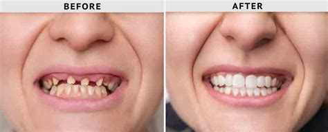 Full Mouth Reconstruction with Implants in Tijuana - BioDental Care Tijuana