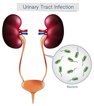 Pediatric Urinary Tract Infections | Doernbecher Children's Hospital | OHSU