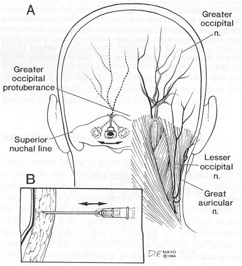 Case Study: Occipital Neuralgia - Briz Brain & Spine Radiofrequency ...