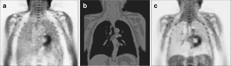 Soft-tissue attenuation correction (AC) of PET images based on MRI... | Download Scientific Diagram