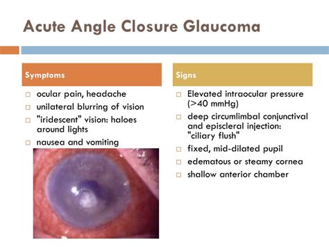 Acute Angle Glaucoma Symptoms