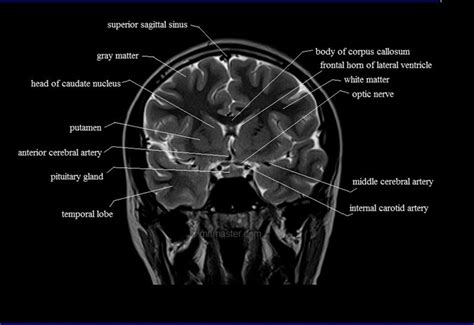 MRI brain coronal cross sectional anatomy image | Mri brain, Brain ...