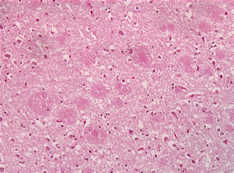 File:Amyloid plaques alzheimer disease HE stain.jpg - Wikimedia Commons