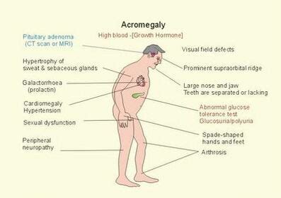 Acromegaly - Physiopedia