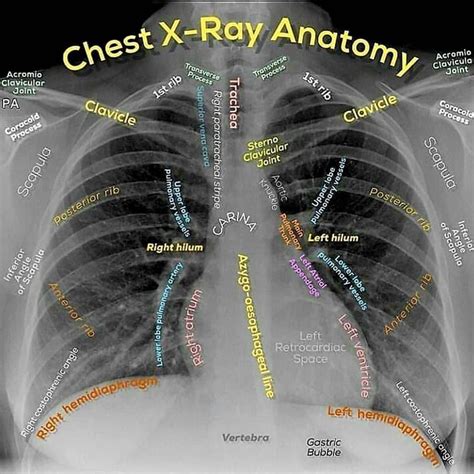 CCU - Chest X Ray Anatomy #CCU_RAY