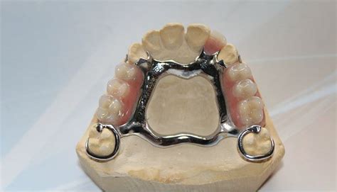 Upper Partial Denture