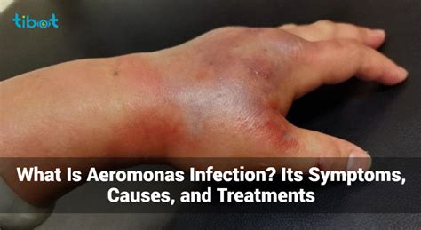 What Is Aeromonas Infection? - Symptoms, Causes & Treatments