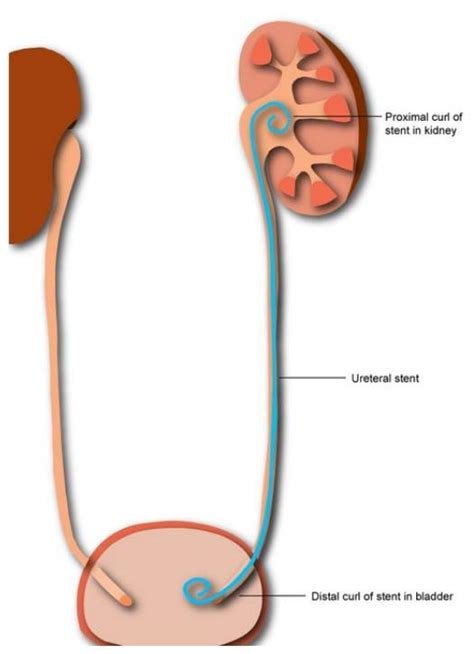 Ureteric Stent - Going home - Milton Keynes University Hospital