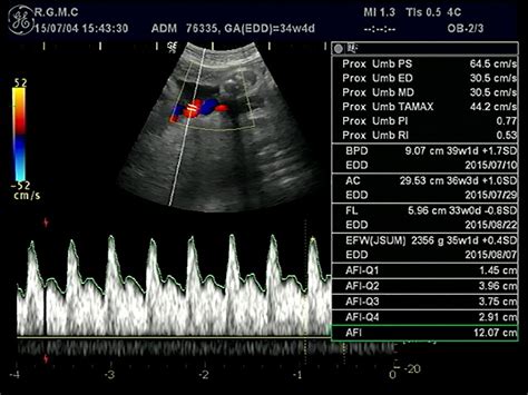 Notching in the Umbilical Artery Doppler Waveform in the Absence of Cord and Placental ...