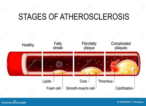 Atherosclerosis Stages