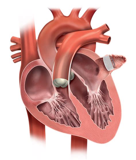 Managing AF & Stroke Risk | WATCHMAN Device