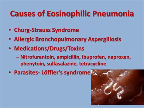 PPT - Chronic Eosinophilic Pneumonia PowerPoint Presentation, free ...