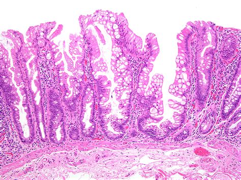 Sessile serrated polyp of the colon and rectum | MyPathologyReport.ca