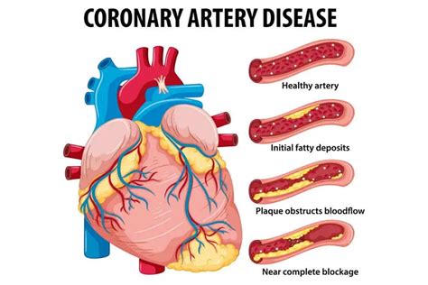 Coronary Artery Disease: A Comprehensive Overview - Longmore Clinic