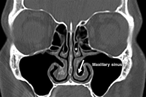 CT of Anatomic Variants of the Paranasal Sinuses and Nasal Cavity: Poor Correlation With ...