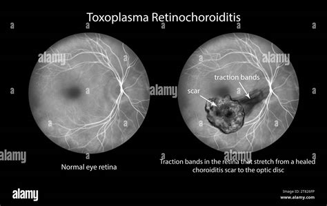 Illustration depicting Toxoplasma retinochoroiditis observed during ...