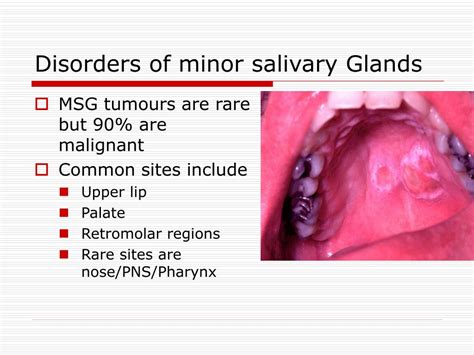 Salivary Gland Lesions