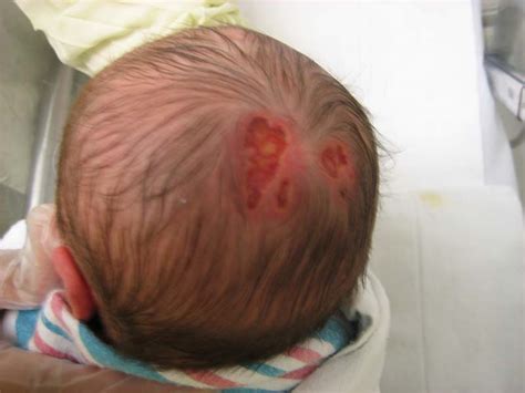 Aplasia Cutis Congenita (congenital skin anomaly) - Dermatology Advisor