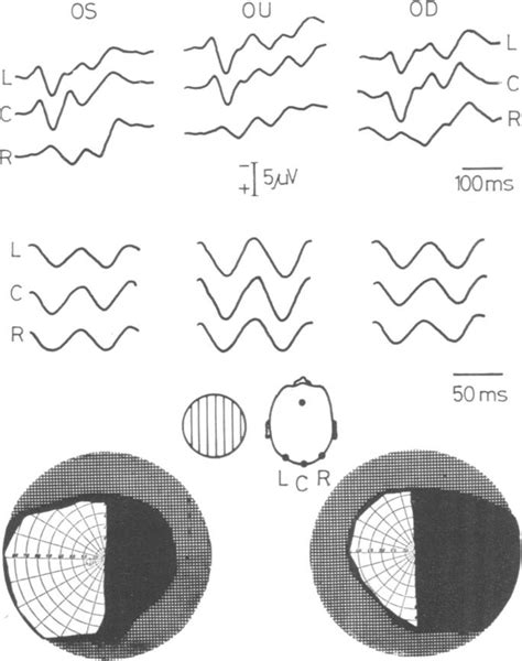 Perimetry charts showing right homonymous hemianopia due to... | Download Scientific Diagram