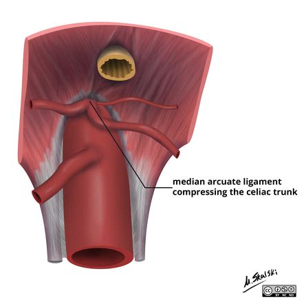 Arcuate Ligament Syndrome