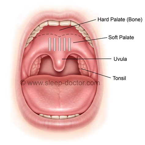 Pillar Procedure - Sleep Doctor