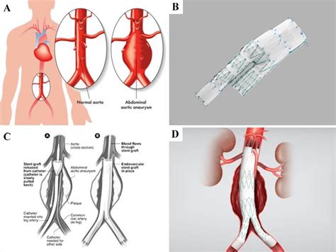 Figure 4-5 from Predicting Advanced Endovascular Aneurysm Repair Complications Using 3D ...