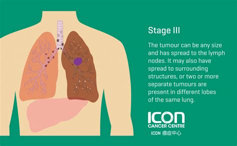 can lung cancer chest pain go away Lung cancer symptoms signs hk