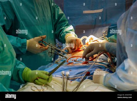 Procedure of coronary artery bypass graft CABG for the operation a ...