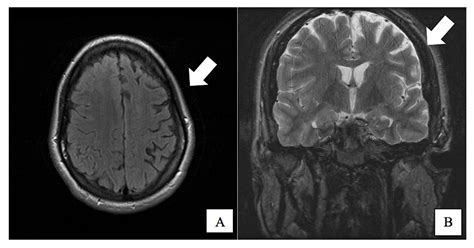 Cureus | Case Report: Rasmussen’s Encephalitis Treated Successfully ...