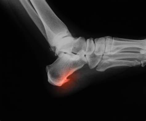 What are bone spurs? | Corpus Christi, Texas