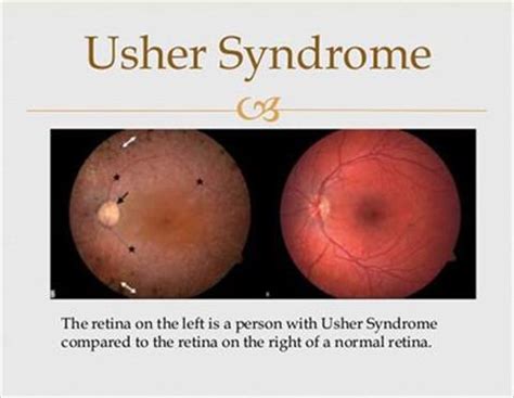 Usher Syndrome