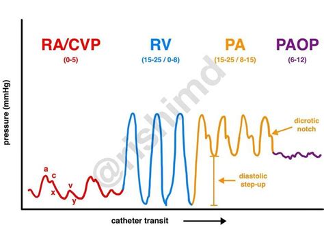 Pulmonary Artery Catheter Waveforms