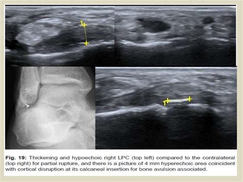 Presentation1.pptx. ultrasound examination of the ankle joint.