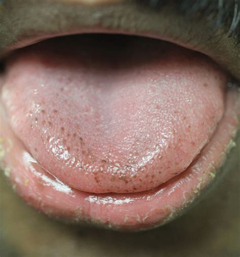 Pigmented Fungiform Papillae of the Tongue in an Indian Male | MDedge Dermatology