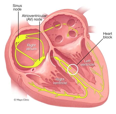 Bundle branch block - Symptoms & causes - Mayo Clinic