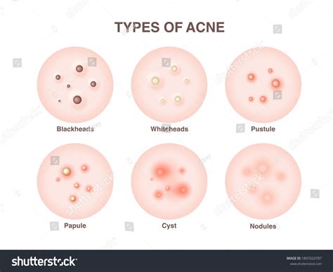 Nodule Skin