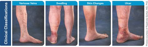 Vein Disease Symptoms | CVD Vein