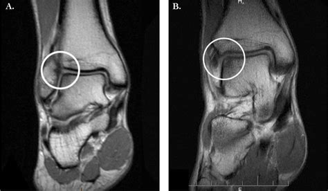 Osteochondral defects of the talus with a focus on platelet-rich plasma as a potential treatment ...